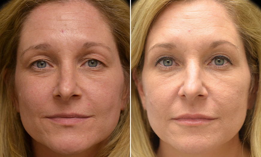 Canthoplasty & Canthopexy NJ Results