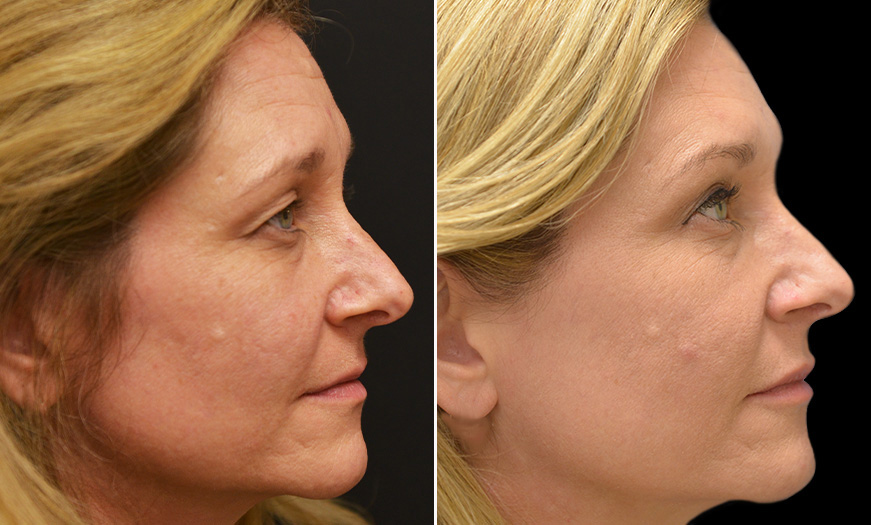 Canthoplasty & Canthopexy NJ Results Right View