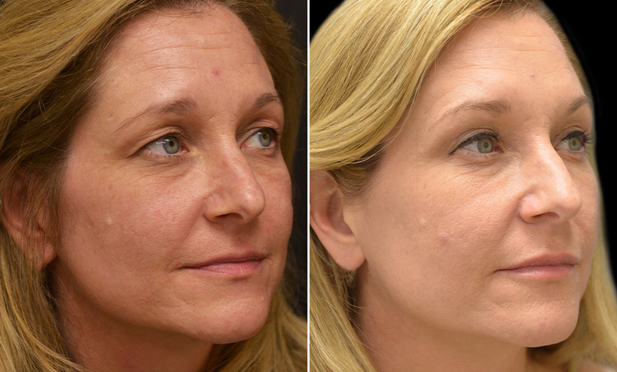 Canthoplasty & Canthopexy NJ Results ¾ Right View