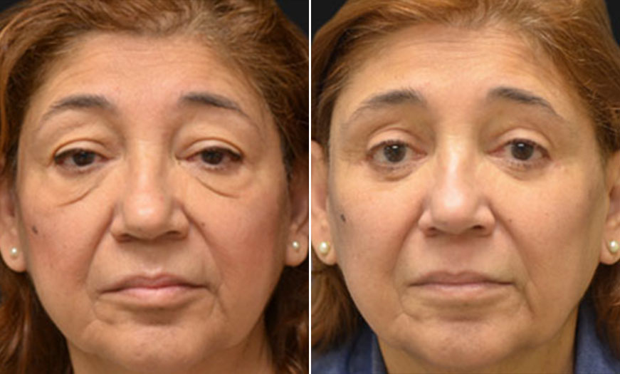 Before & After For Canthoplasty & Canthopexy