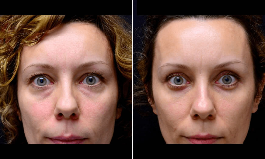 Canthoplasty And Canthopexy Surgical Results