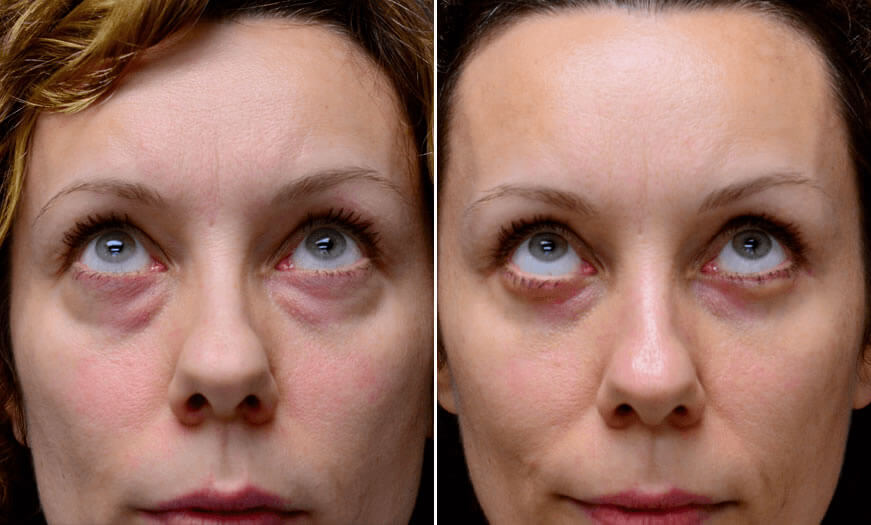 Canthoplasty And Canthopexy Surgical Results Front View