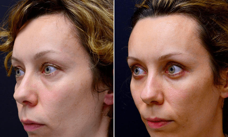 Canthoplasty And Canthopexy Surgical Results ¾ Left View