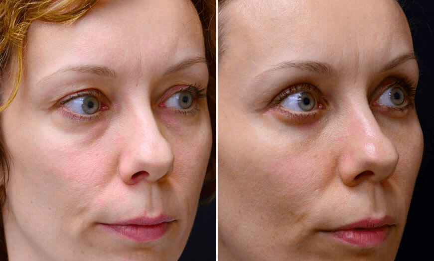 Canthoplasty And Canthopexy Surgical Results ¾ Right View