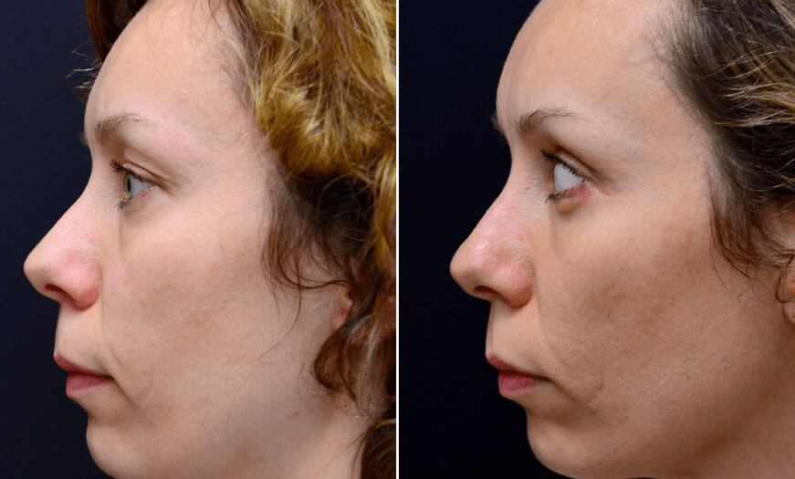 Canthoplasty And Canthopexy Surgical Results Left View