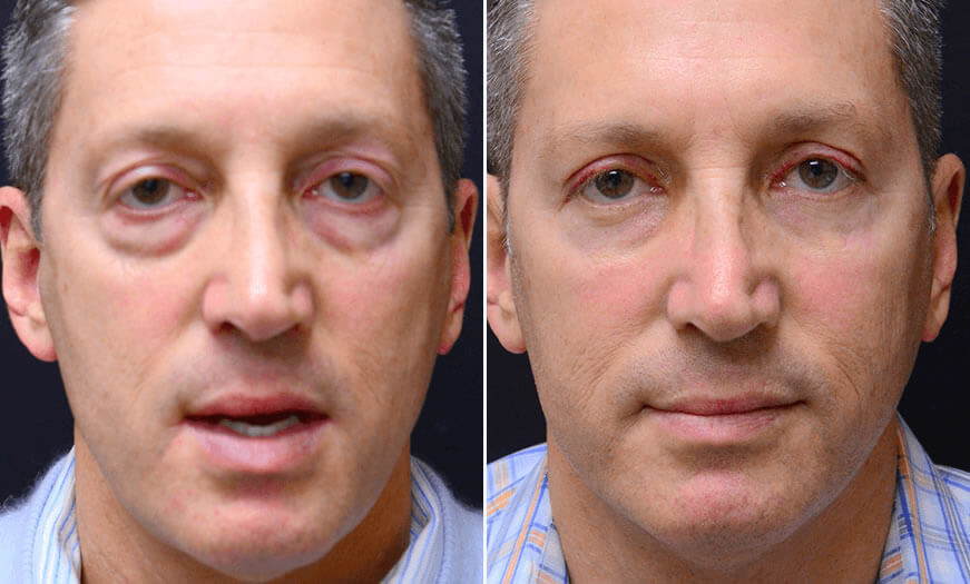 Surgical Results For Canthoplasty And Canthopexy