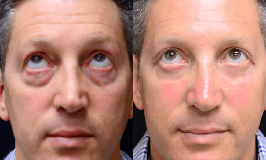 Surgical Results For Canthoplasty And Canthopexy Front View