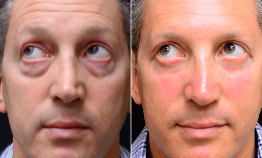 Surgical Results For Canthoplasty And Canthopexy Front View Looking Left