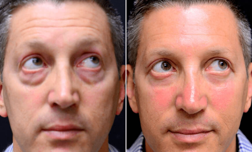 Surgical Results For Canthoplasty And Canthopexy Front View  Looking Right