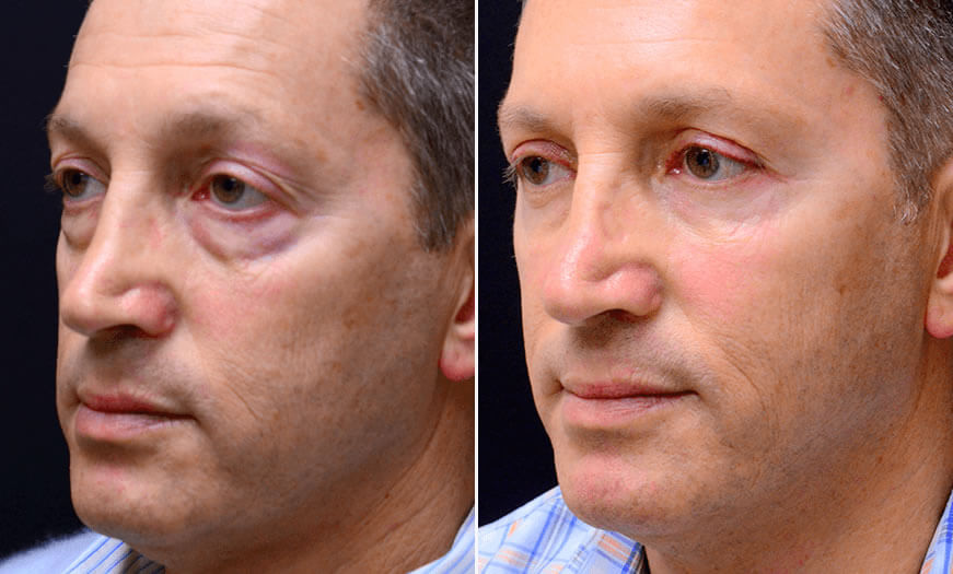 Surgical Results For Canthoplasty And Canthopexy ¾ Left View 