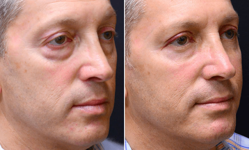 Surgical Results For Canthoplasty And Canthopexy ¾ Right View 