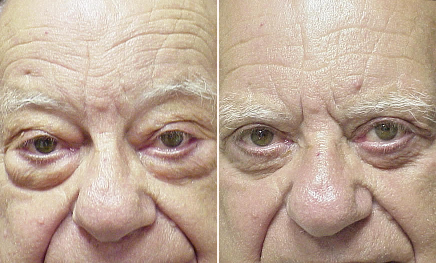 Before And After Canthoplasty/Canthopexy Results