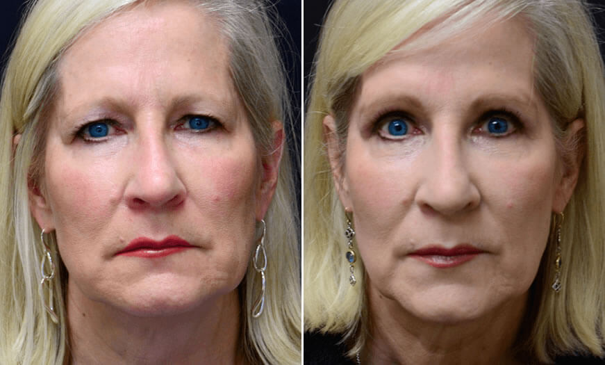 New Jersey Canthoplasty & Canthopexy Results