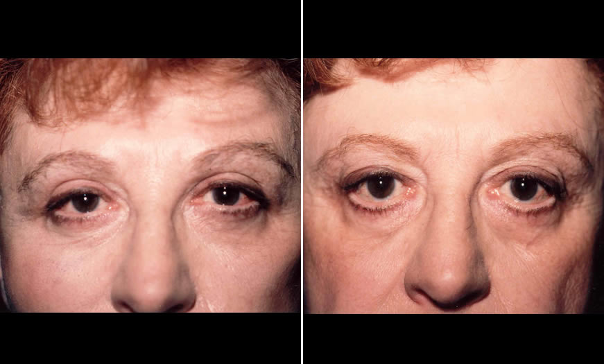 Canthoplasty & Canthopexy Surgical Results