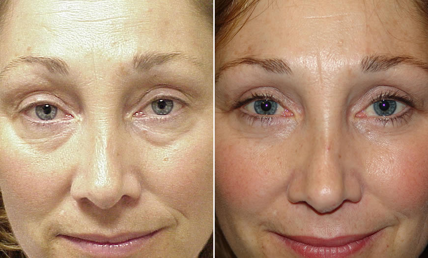 Canthoplasty & Canthopexy Surgical Results NJ