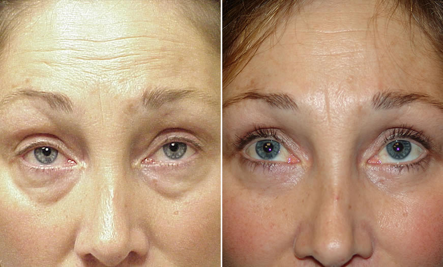 Canthoplasty & Canthopexy Surgical Results NJ Front View