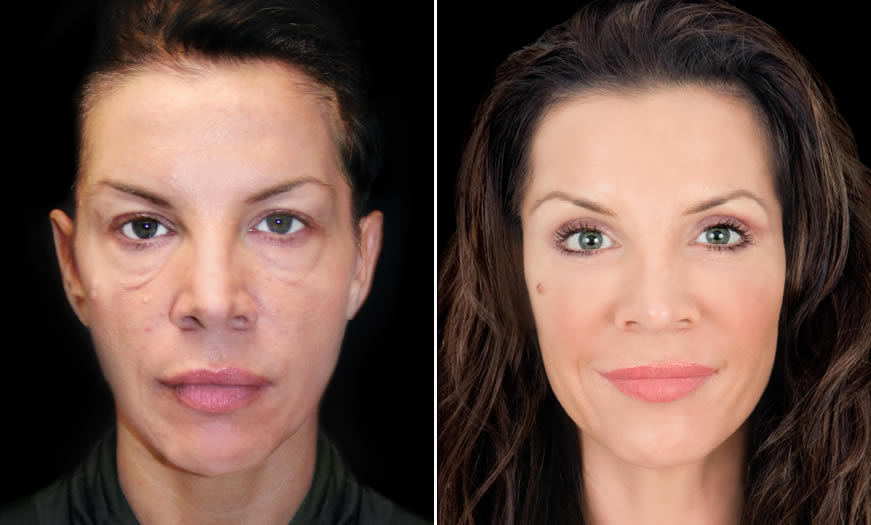 Canthoplasty & Canthopexy Surgical Results In NJ