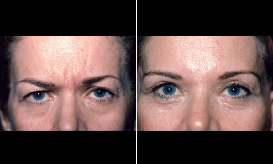 Surgical Results For Canthoplasty & Canthopexy In NJ