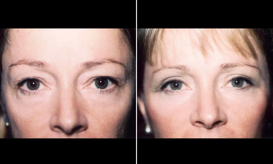 Surgical Results For Canthoplasty & Canthopexy NJ