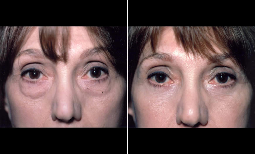 Canthoplasty & Canthopexy Surgical Results New Jersey