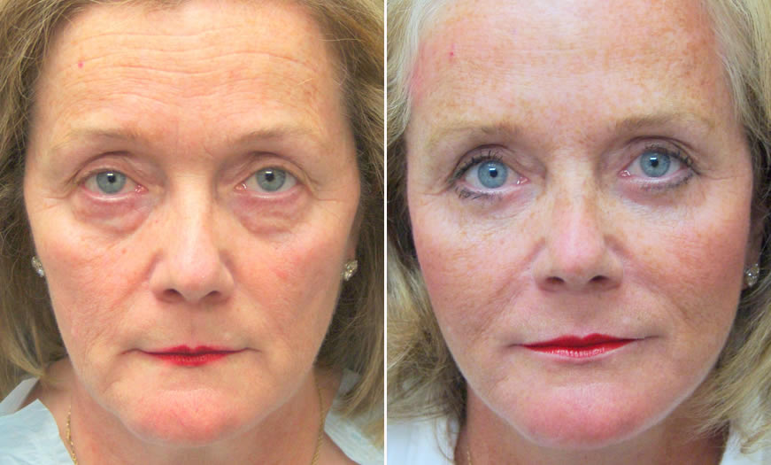 Canthoplasty & Canthopexy Results In New Jersey