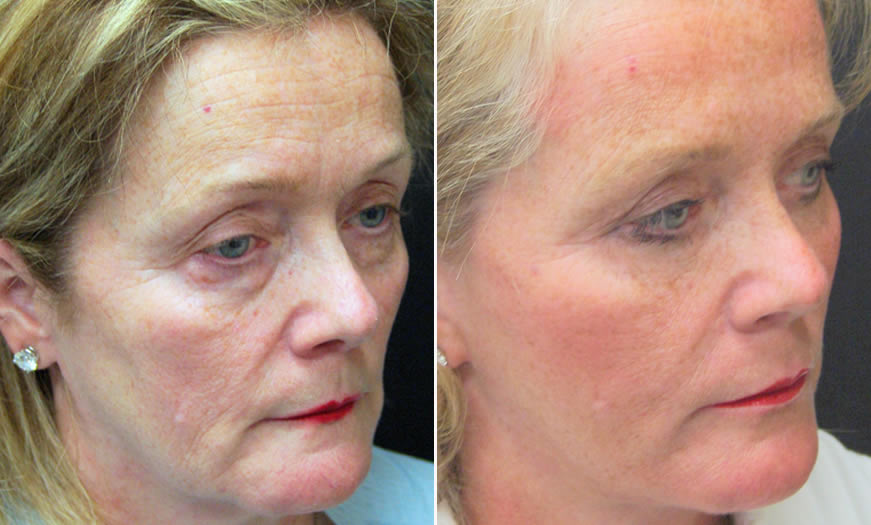 Canthoplasty & Canthopexy Results In New Jersey ¾ Right View