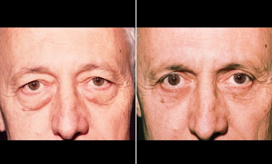 New Jersey Canthoplasty & Canthopexy Surgery