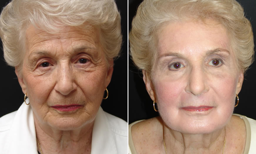 Front View Canthoplasty & Canthopexy Results