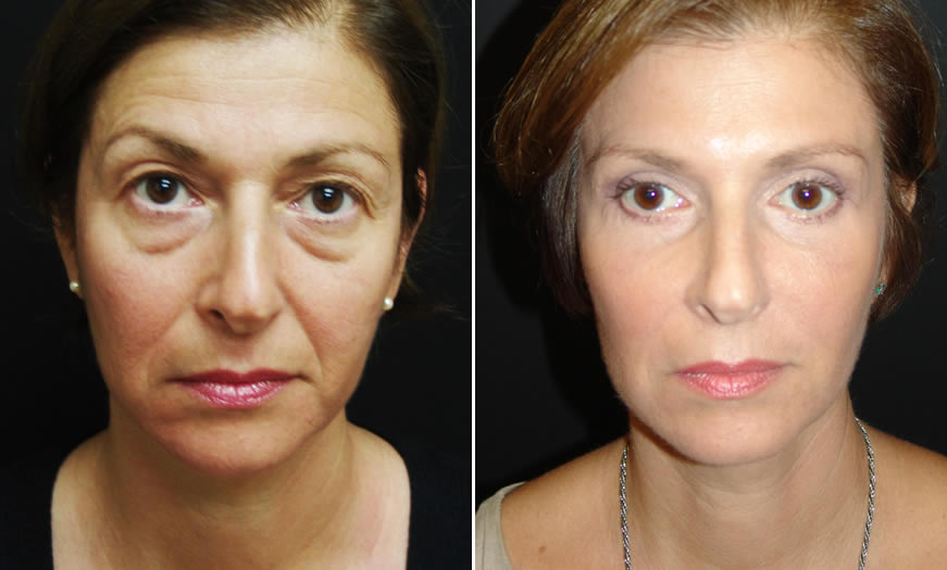 Front View Surgical Results For Canthoplasty And Canthopexy