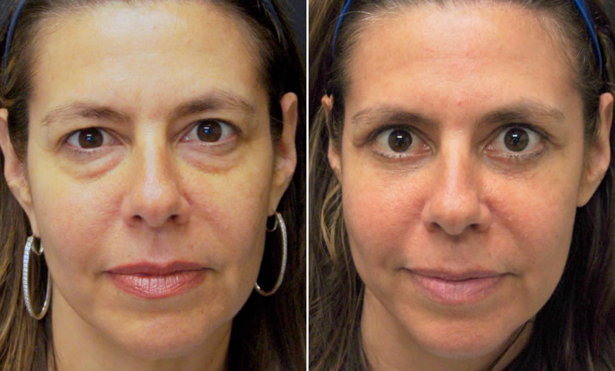 Front View Canthoplasty And Canthopexy Surgery Results