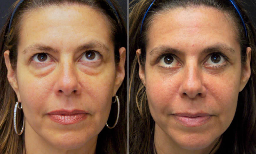 Frontal View Canthoplasty And Canthopexy Surgery Results