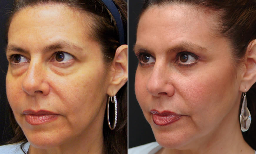 ¾ Left View Canthoplasty And Canthopexy Surgery Results