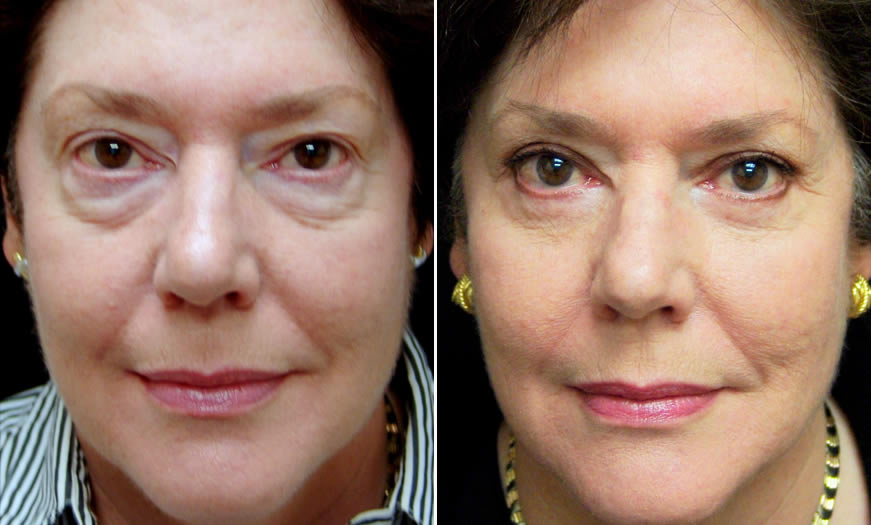 Front View Results Of Canthoplasty And Canthopexy