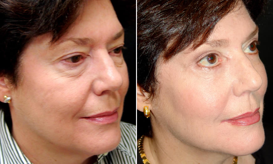 ¾ Right View Results Of Canthoplasty And Canthopexy