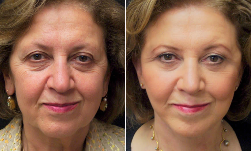 Front View Results For Canthoplasty And Canthopexy