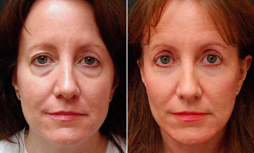 Front View Results Of Canthoplasty & Canthopexy