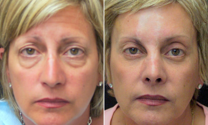 Front View Results Of Canthoplasty & Canthopexy NJ