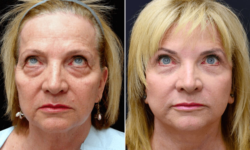 Canthoplasty/Canthopexy In NJ