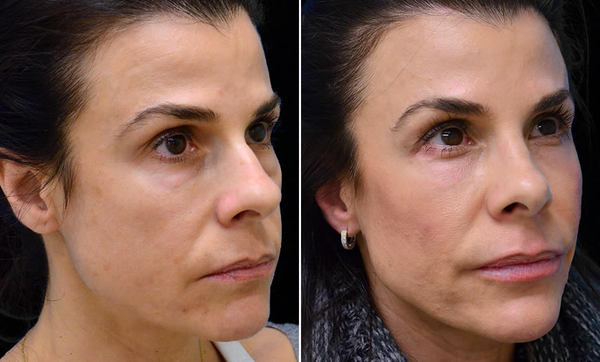 Canthoplasty And Canthopexy In NJ Results ¾ Right View