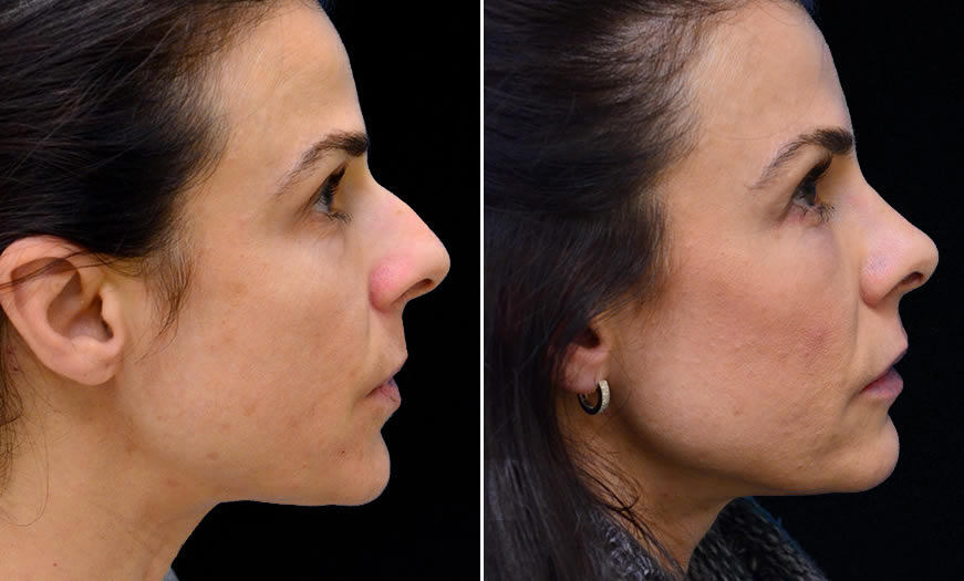 Canthoplasty And Canthopexy In NJ Results Right View