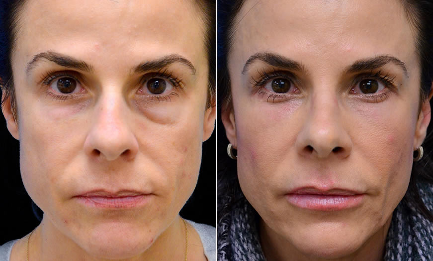 Canthoplasty And Canthopexy In NJ Results