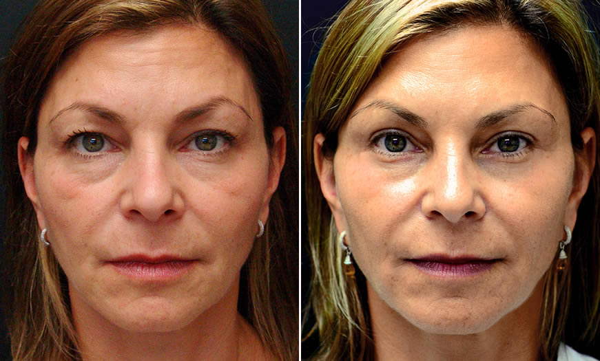 Canthoplasty/Canthopexy Results In NJ