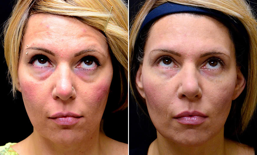 Canthoplasty & Canthopexy Eye Surgery New Jersey Front View