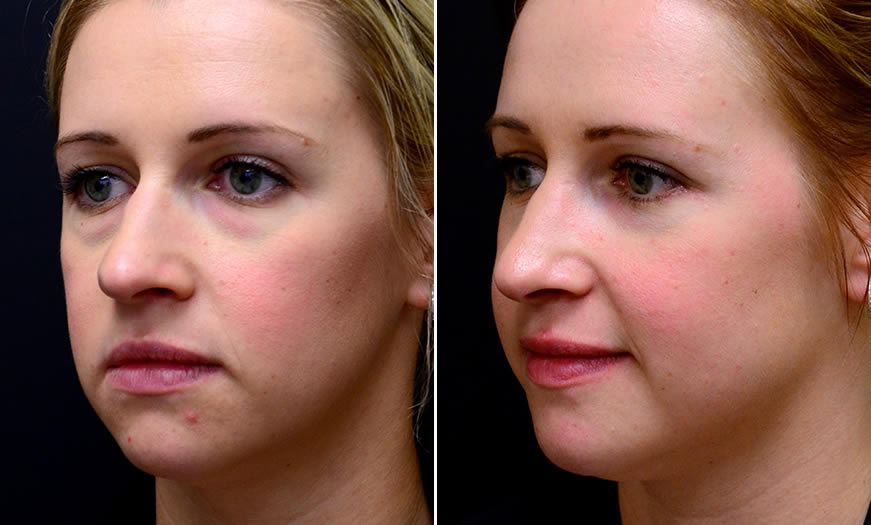 Canthoplasty & Canthopexy Surgery In New Jersey ¾ Left View