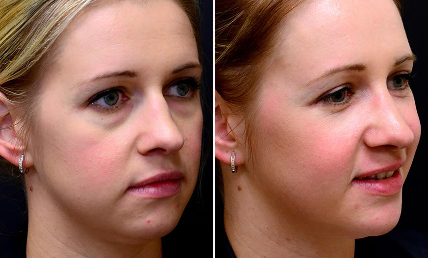 Canthoplasty & Canthopexy Surgery In New Jersey ¾ Right View