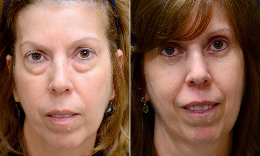 Canthoplasty & Canthopexy Surgery Results In New Jersey