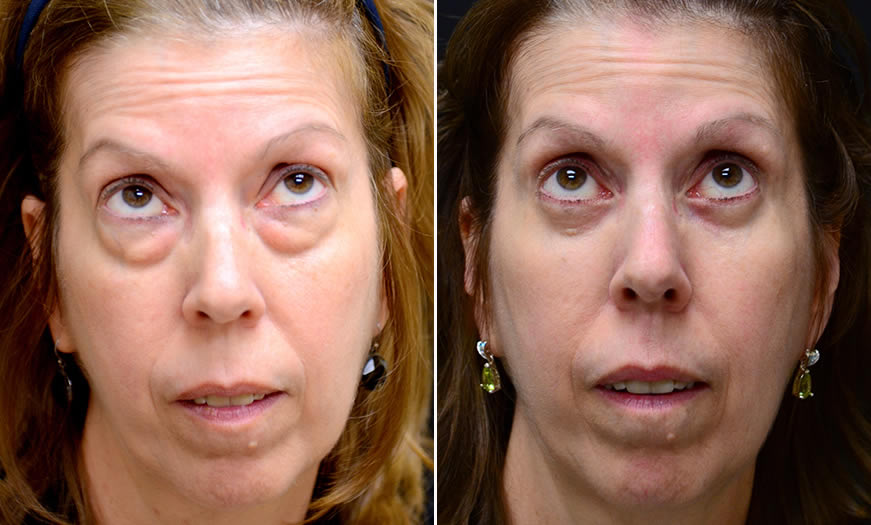 Canthoplasty & Canthopexy Surgery Results In New Jersey Front View