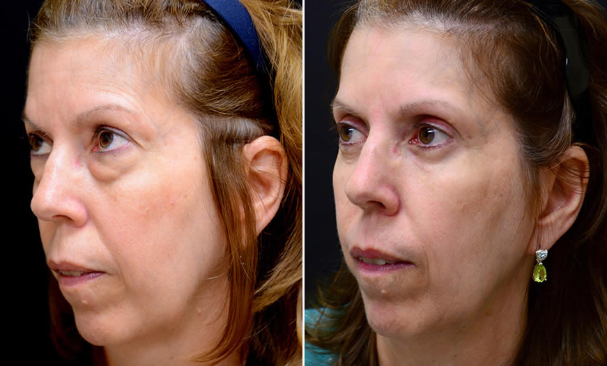 Canthoplasty & Canthopexy Surgery Results In New Jersey ¾ Left View