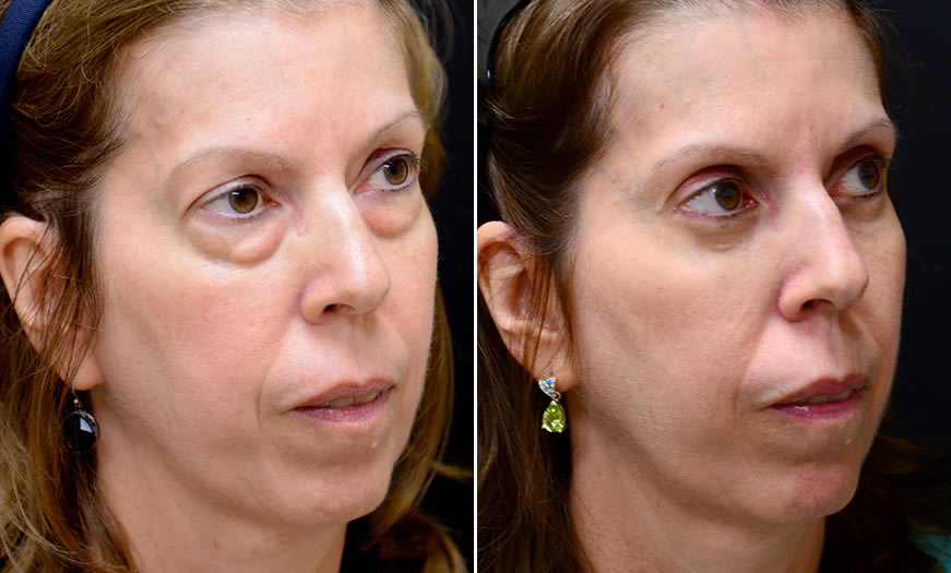 Canthoplasty & Canthopexy Surgery Results In New Jersey ¾ Right View