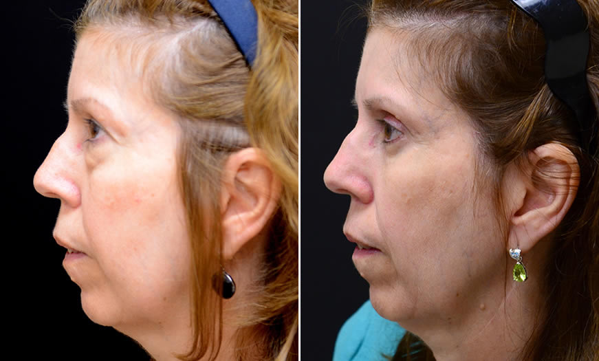 Canthoplasty & Canthopexy Surgery Results In New Jersey Left View